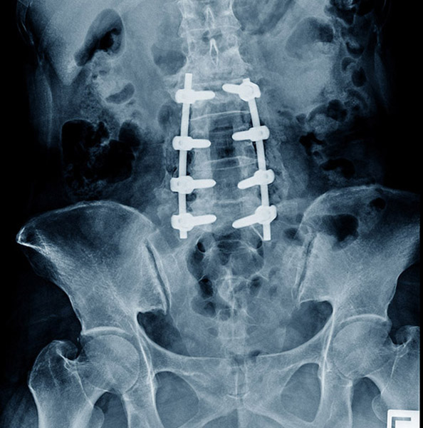 x-ray of a spine after a TLIF procedure performed by dr. hanbing zhou