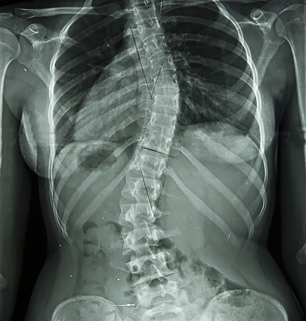 x-ray of a spinal deformity to be corrected using the posterior lumbar inter body fusion surgical technique by Dr. hanbing zhou
